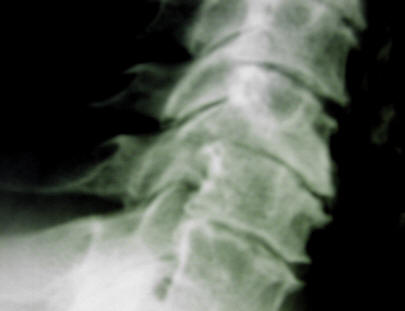 neck OA